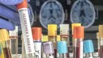 Alzheimer'a Son: FDA Onaylı İlk Test Kitiyle Erken Teşhis Mümkün!